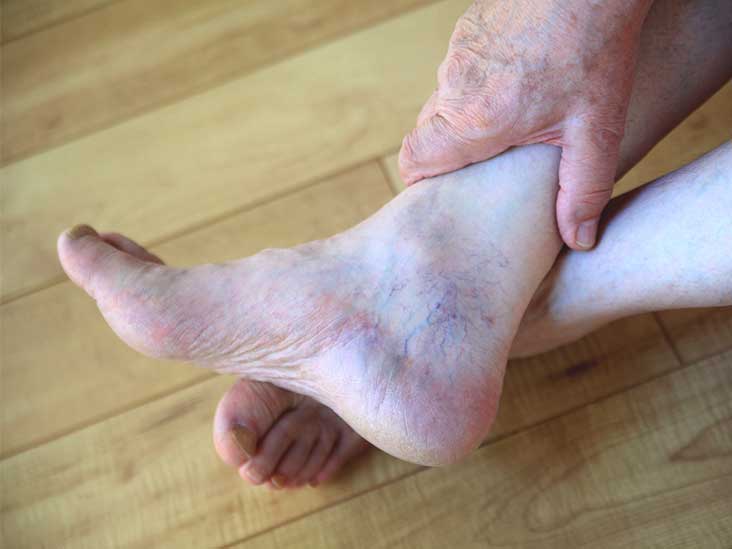 psoriasis on feet and hands