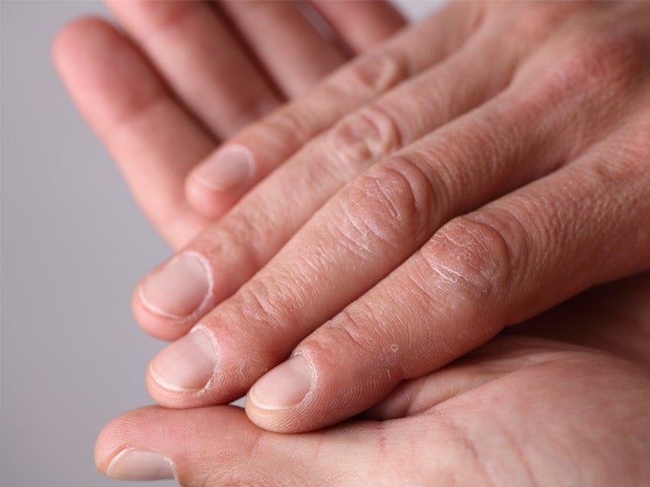 Stress Lines On Nails