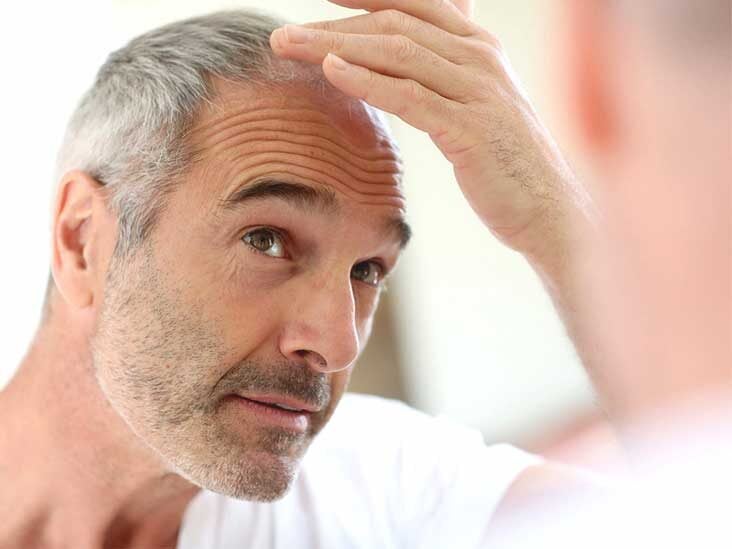 does exercise and diet cause hair loss