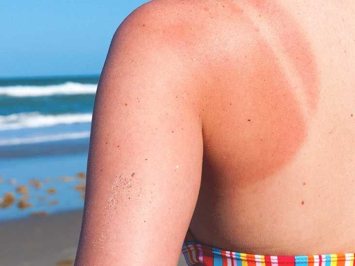 sun cream rash