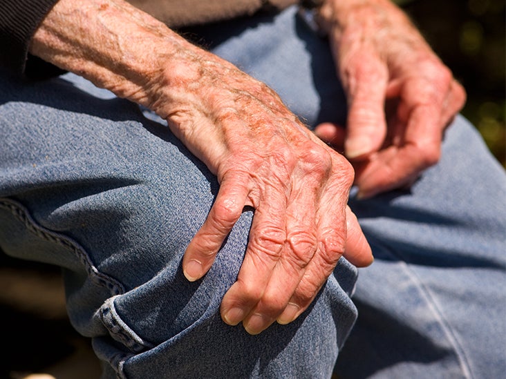 Ízületi tünetek polyarthritis és kezelése, Mi az a rheumatoid arthritis?