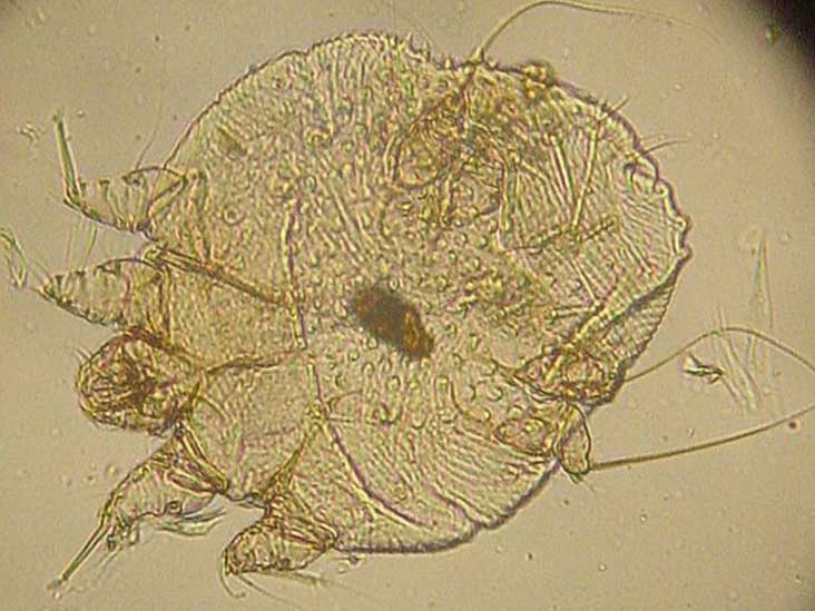 Scabies Bites Pictures Symptoms And Treatments