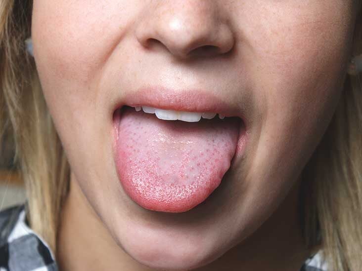 what causes papilloma on the tongue