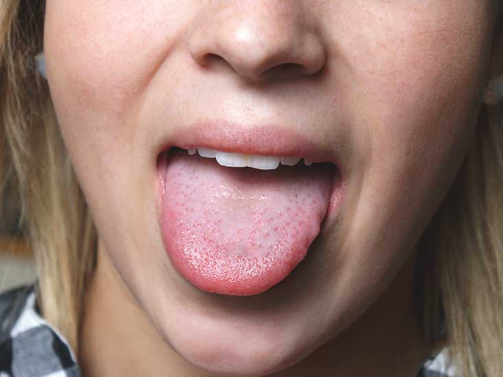 can vitamin d deficiency cause hongue tongue