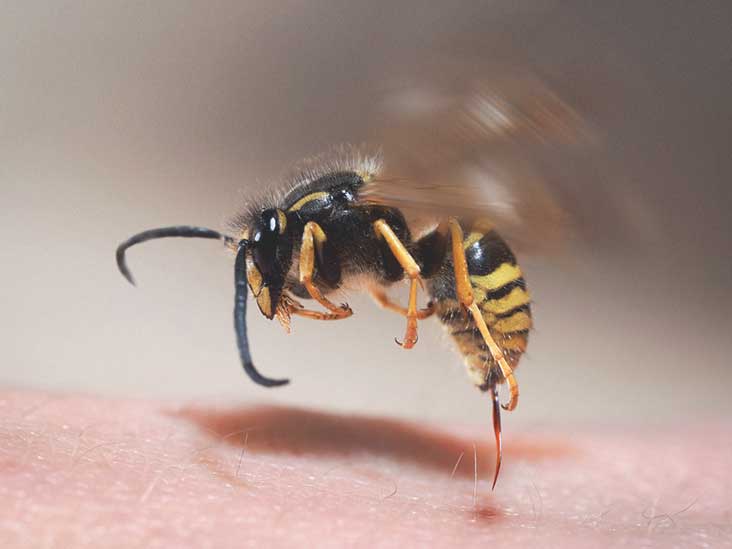 Yellow Jacket Wasp Sting