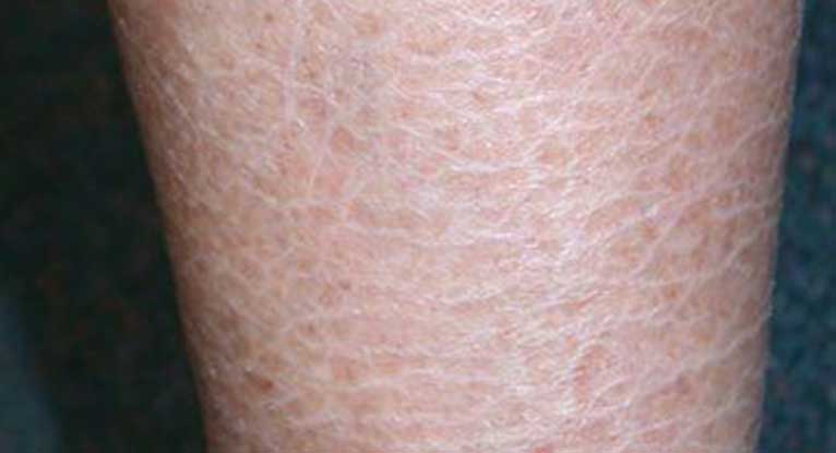 Hard Dry Skin Patches On Legs