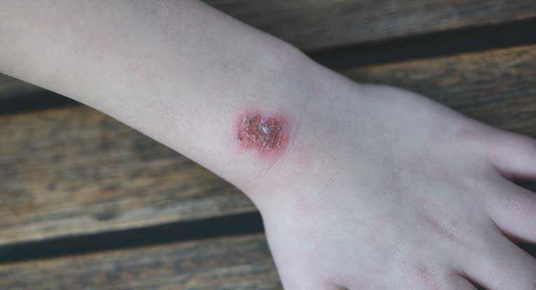 Is It Safe To Visit Someone Who Has Mrsa