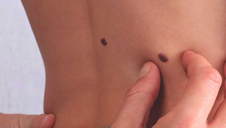 Follow News Without Politics, news without bias, What causes skin tags and how to treat them