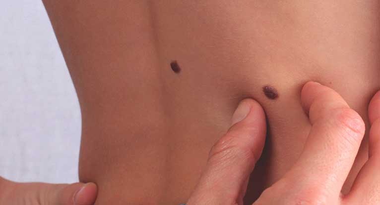 How to Remove Skin Tags, Causes, and More