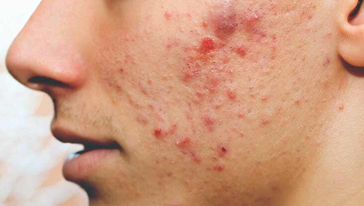 What helps redness of pimples