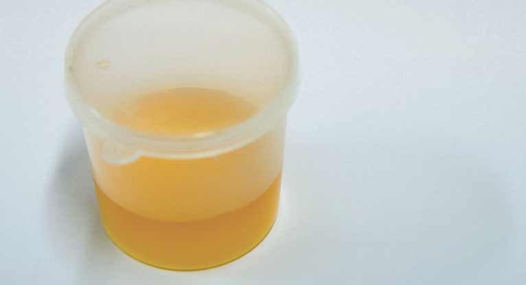 Leukocytes In Urine What You Should Know 2750