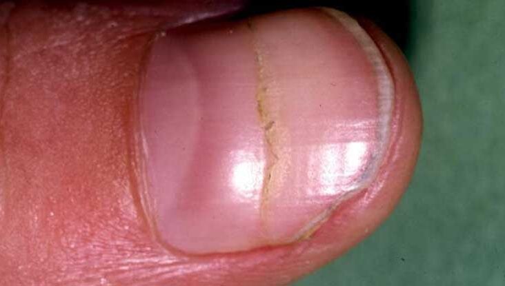 Half Moon Nails Why You Do Or Don T Have It Symptoms To Watch For