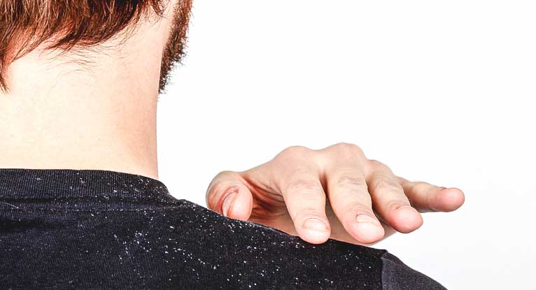 How to Get Rid of Dandruff: 9 Home Remedies
