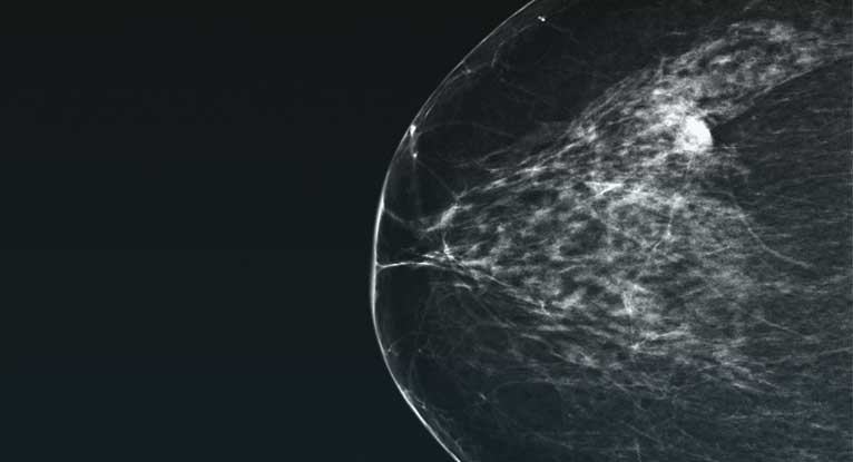 Tomosynthesis advantages and disadvantages picture