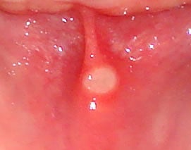 Canker Sore: Treatments, Causes, and Symptoms