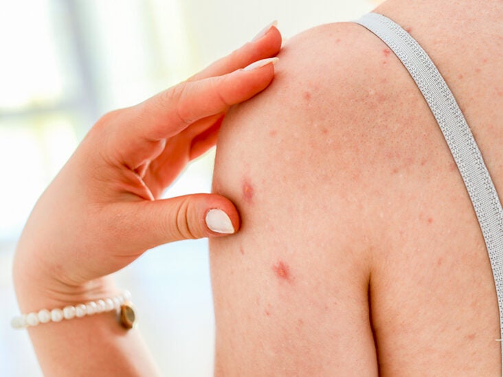 hpv dry skin patches