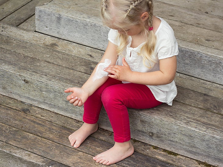 Eczema (Atopic Dermatitis): Types, Causes, Treatment, and More