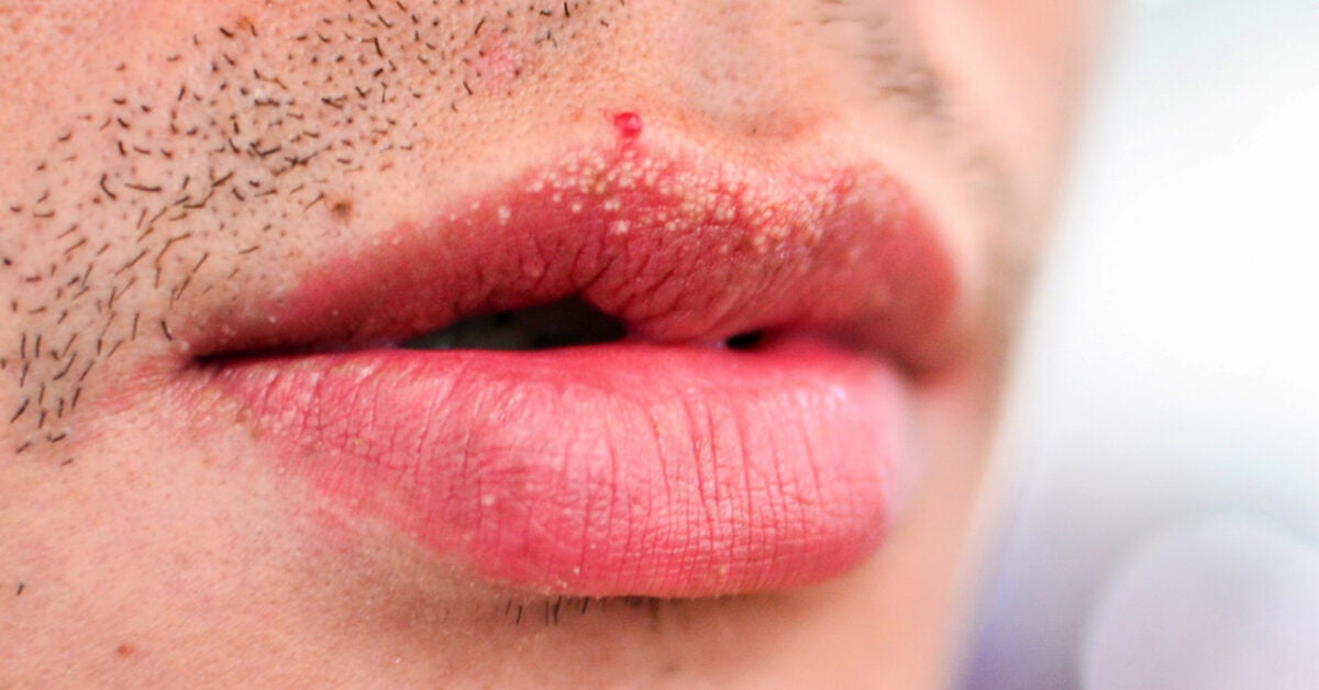 White Patches On Lips Corner