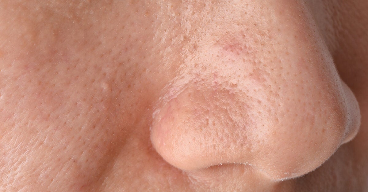 Sebaceous Filaments: About, Vs. Blackheads, Why to Leave Alone