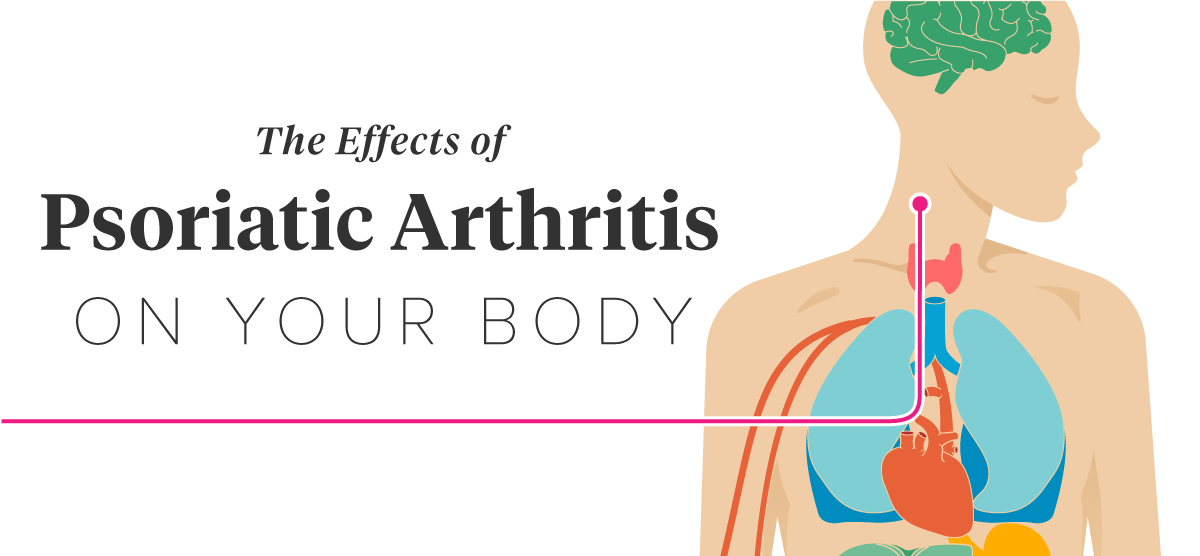 12 Effects Of Psoriatic Arthritis On The Body   Psoriatic Arthritis Effects Facebook 