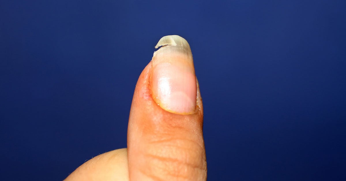 Split Nail Causes Treatment And Prevention