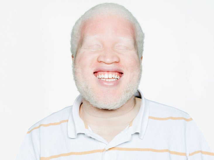 Albinism Causes Types And Symptoms