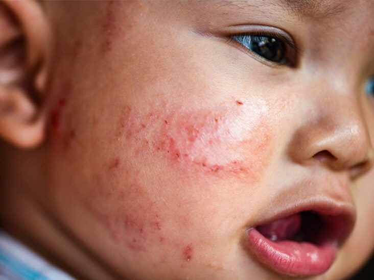 Hydrocortisone for baby eczema