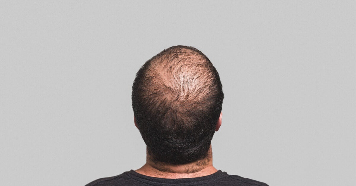 One male hair loss treatment works better than others study finds  CNN