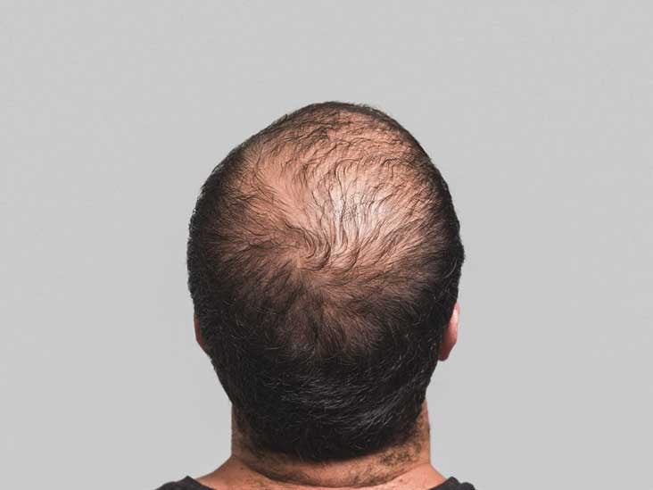 PRP for Hair Loss: Efficacy, Safety, and Cost