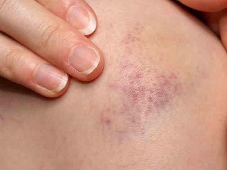 Purpura: Causes, Diagnosis, and Pictures