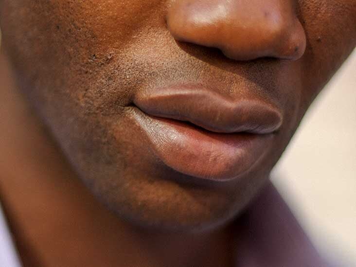 Discolored Lips What It Means And How To Treat Them