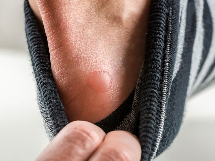Everything You Should Know About Diabetic Blisters