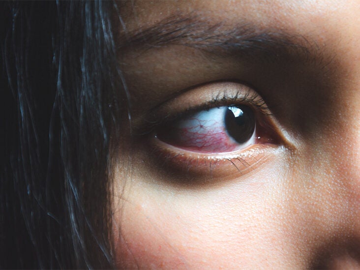 Watery Eyes: When to a Doctor &