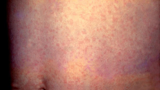 Measles: Symptoms, Diagnosis, and Treatments