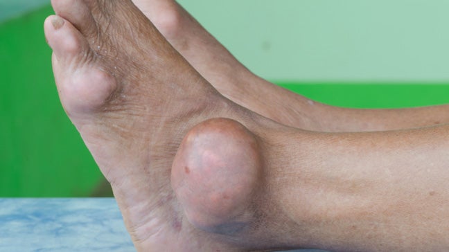 gout bottom of foot