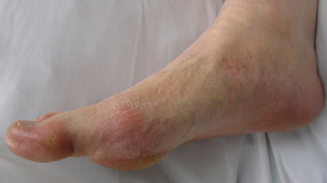 heel pain due to uric acid
