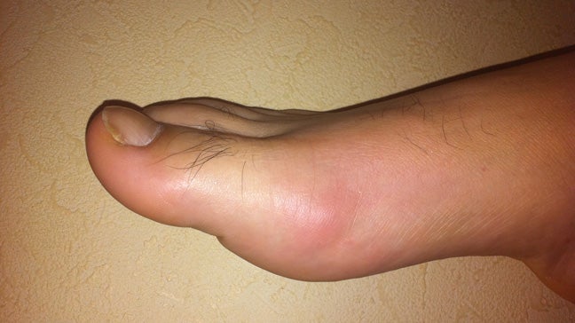 gout in heel of feet