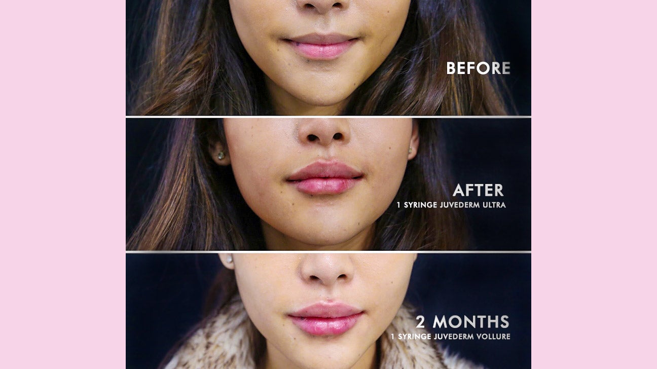 Restylane vs. Juvederm for Lips What’s the Difference?
