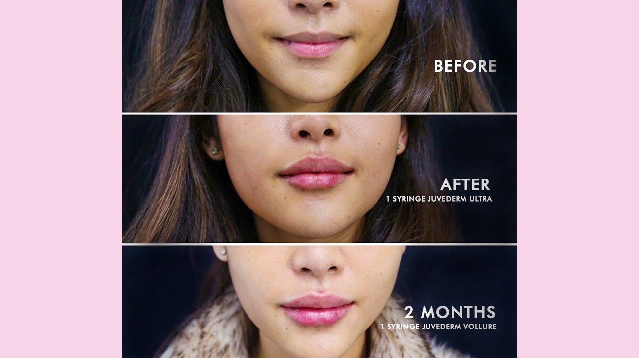 Juvederm Lips Before And After 12 Syringe Lips The Results Can