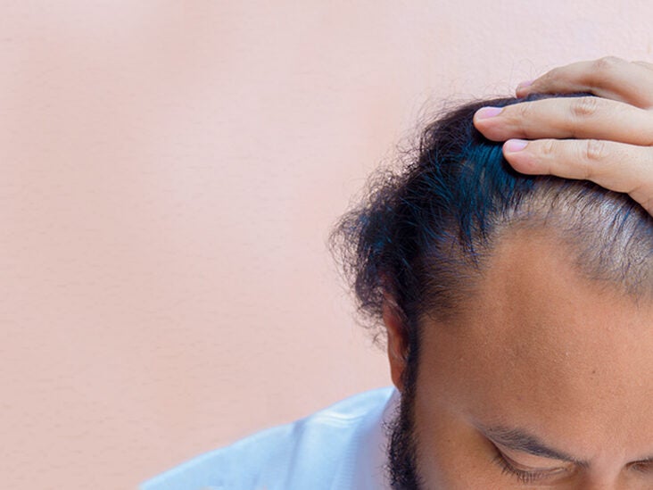 Thinning Hair in Men: 11 Tips to Treat and Cover Hair Loss