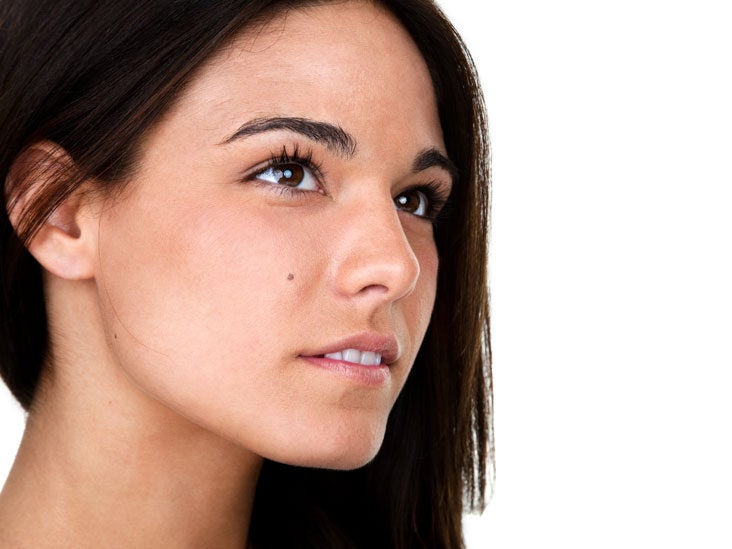 Melasma Symptoms Diagnosis And Treatments