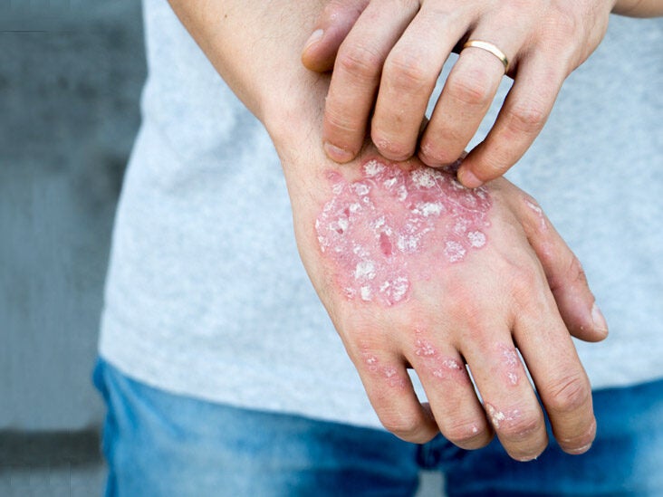 does psoriasis cause stress)