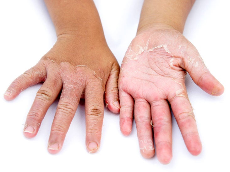 dry peeling skin on hands