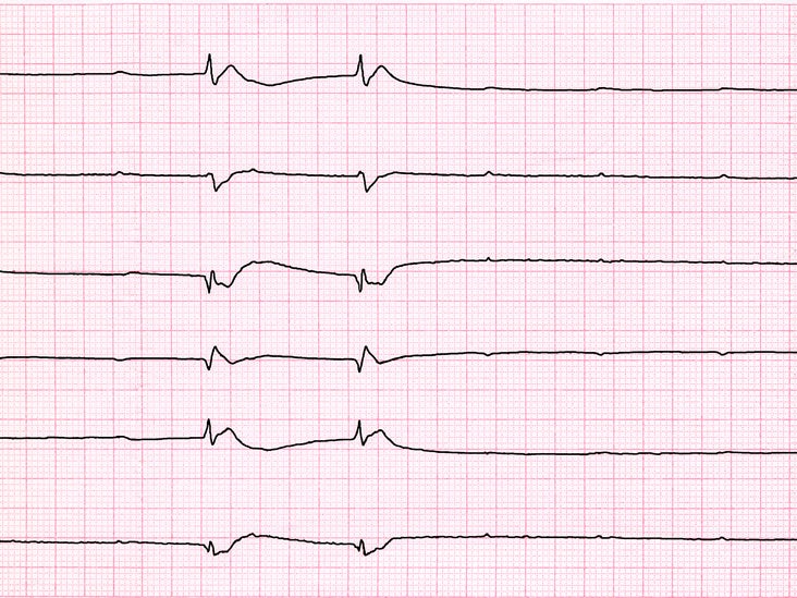 sick-sinus-syndrome-types-risk-factors-causes