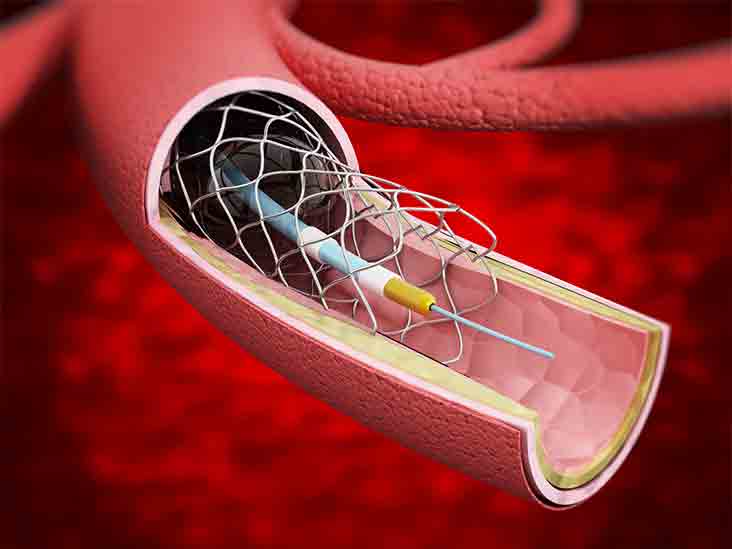 what is a heart stent procedure
