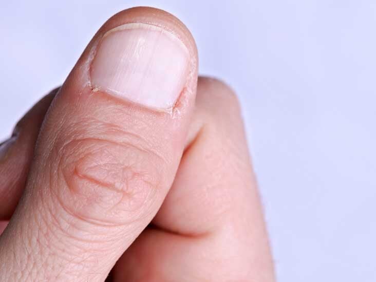 Yellow Nail Syndrome: Symptoms, Causes, and Treatments