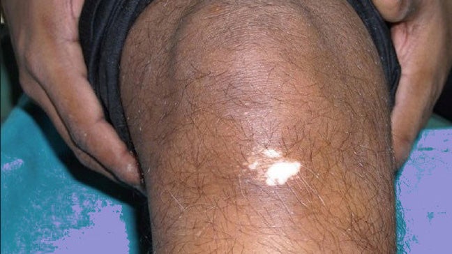 Of the penis vitiligo Why is