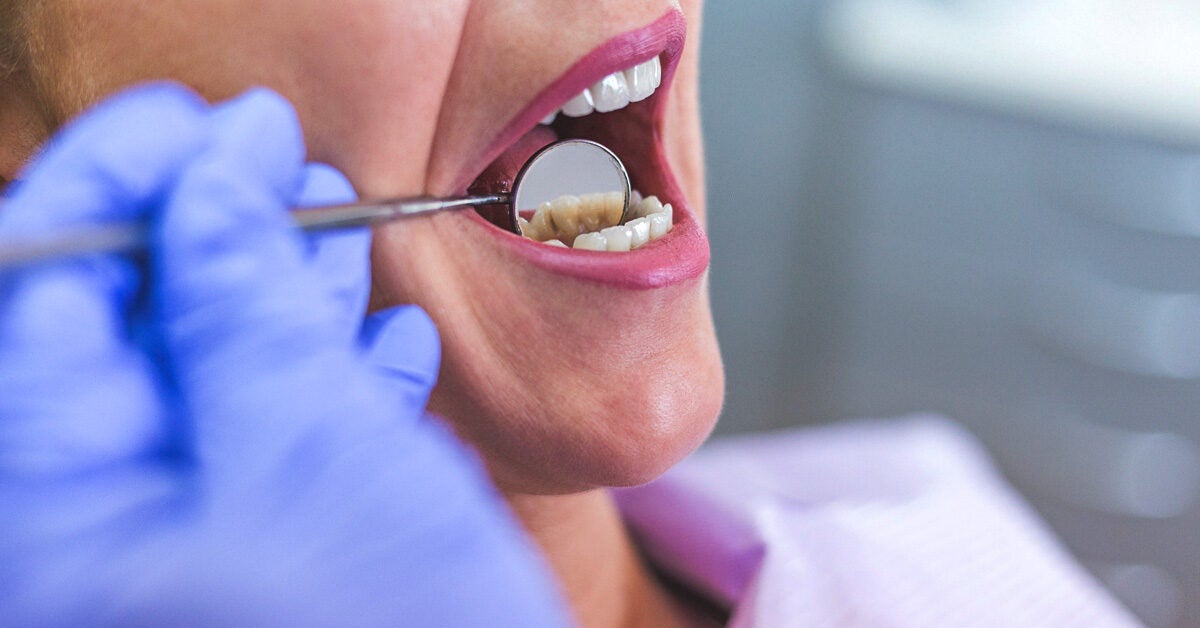 baking soda on abscess tooth