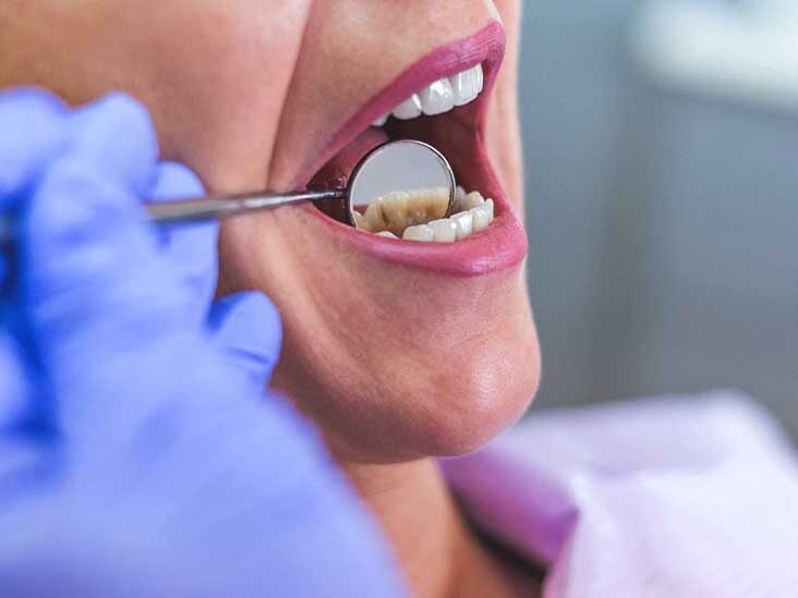 woman teeth dentist 732x549 thumbnail