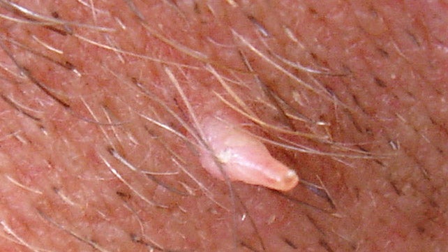 filiform wart scalp